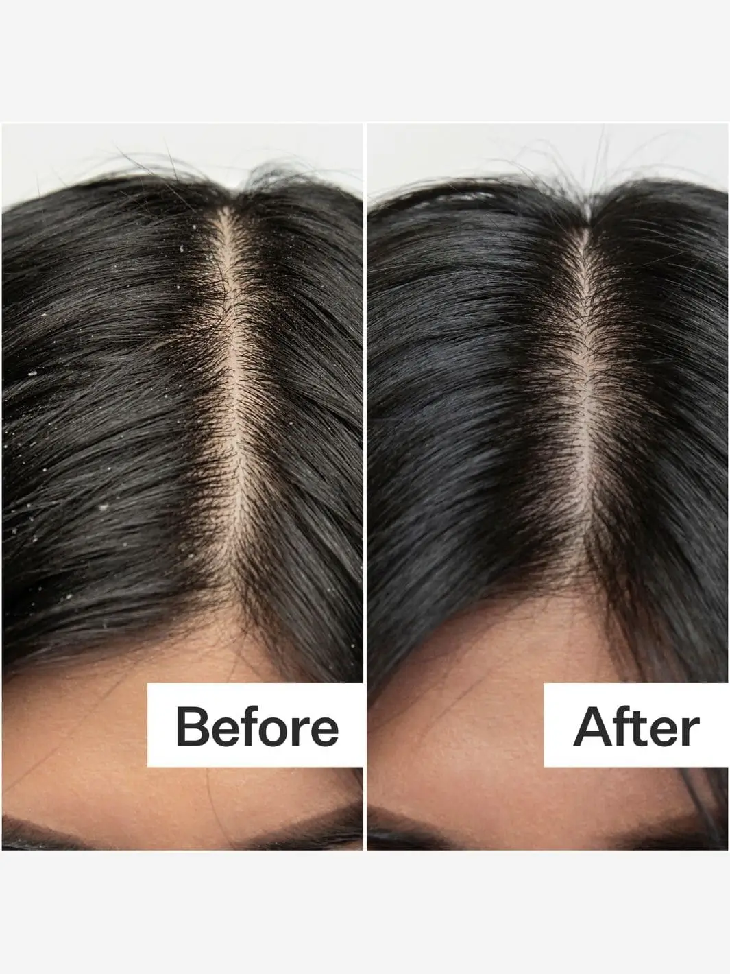 BHA Salicylic Acid Scalp Exfoliator (Scalp Renew) - Image 4