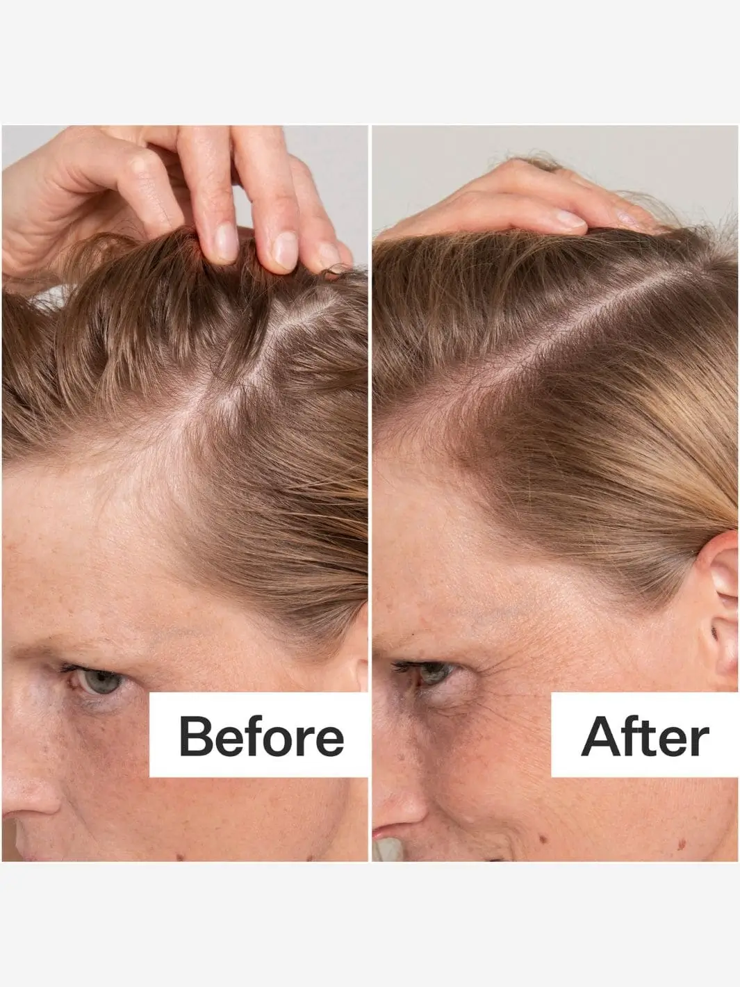BHA Salicylic Acid Scalp Exfoliator (Scalp Renew) - Image 5
